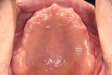 임플란트틀니 - 오버덴쳐. 오스템BA임플란트 이용한 최고의 가성비 치료. 치료과정/치료기간/비용/후기. 관련 이미지 17