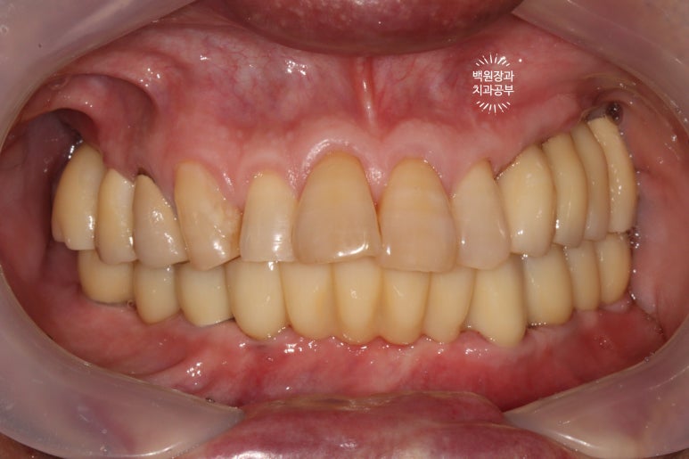 아래 어금니 임플란트 6개면 틀니를 안써도 됩니다.  치주염 전문 착한치과. 치료기간/임시치아과정/후기/비용. 관련 이미지 24