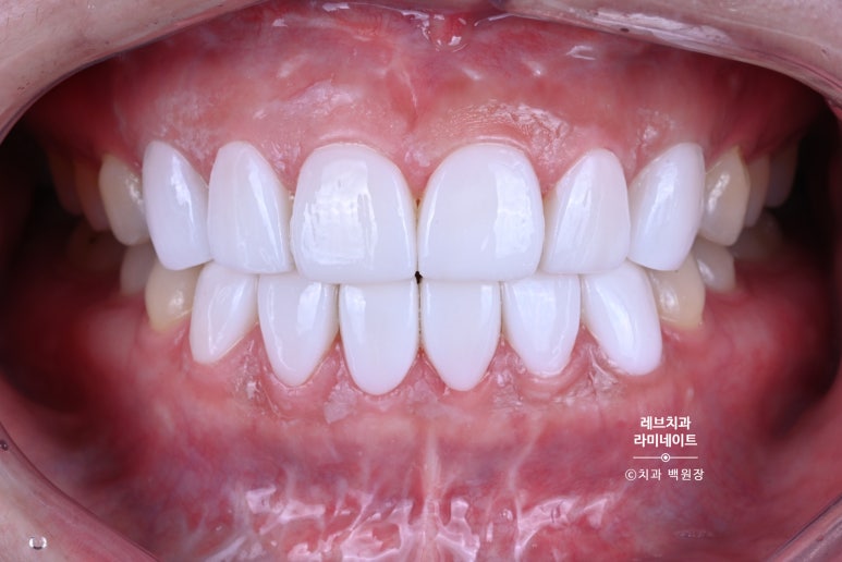 레브네이트 베이직. 치아미백과 치아교정을 한번에! 치아삭제 사진 있음. 신사역 치과 앞니라미네이트 모델/비용/후기. 관련 이미지 16