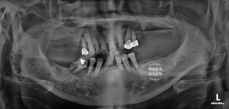 임플란트장인의 마음으로 8개월간 전체임플란트 완성. 치주과 전문의. 관련 이미지 2