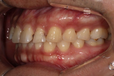 교정 유지장치 근처 앞니 옆면 충치 및 착색 간단히 3M 레진으로 치료. 치료과정/비용/후기. 과잉진료 없는 치과. 관련 이미지 12