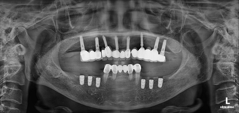 부분틀니를 오래써서 어금니가 아플 때, 아래턱 양쪽 어금니 임플란트 잘하는 강남임플란트치과 관련 이미지 13