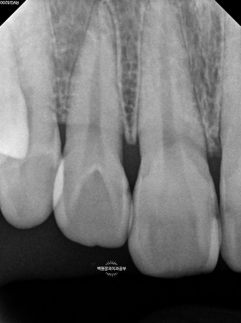 앞니레진치료 할 줄 모르는 치과의사는 없지만, 좋은 레진으로 치료하는 치과의사는 잘 없습니다. 관련 이미지 17