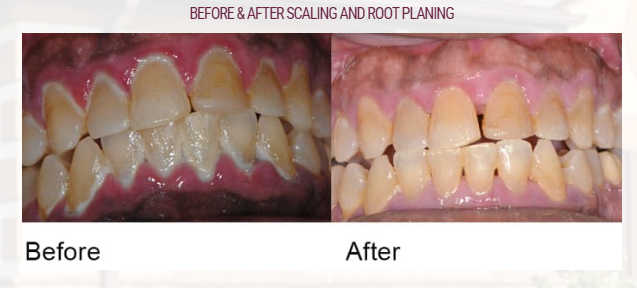잇몸치료와 앞니 레진치료. 3년이 지난 모습 궁금하지 않으신가요? 3M 레진쓰는 치과. 후기/시간/과정/비용. 관련 이미지 4
