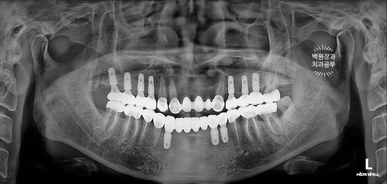 뿌리만 남은 앞니, 어금니가 없어 교합이 무너진 증례. 흡연자의 전체 오스템BA임플란트 재건증례. 치료과정/치료기간/비용/후기. 관련 이미지 30