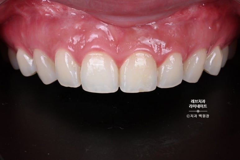 레브네이트 베이직. 치아미백과 치아교정을 한번에! 치아삭제 사진 있음. 신사역 치과 앞니라미네이트 모델/비용/후기. 관련 이미지 6
