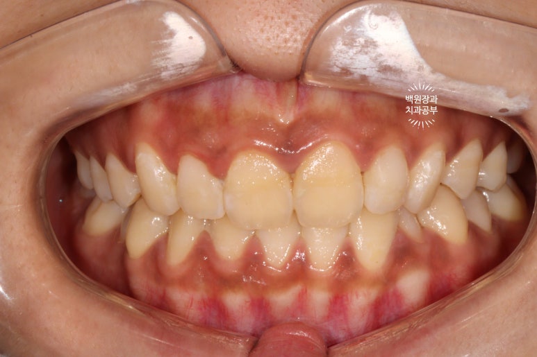 잇몸치료와 앞니 레진치료. 3년이 지난 모습 궁금하지 않으신가요? 3M 레진쓰는 치과. 후기/시간/과정/비용. 관련 이미지 9