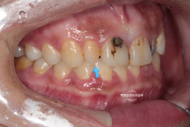 앞니에 잇몸염증과 충치가 심해요. 앞니 지르코니아 크라운 성공 후기. 치료과정/치료기간/비용/전후비교. 관련 이미지 3