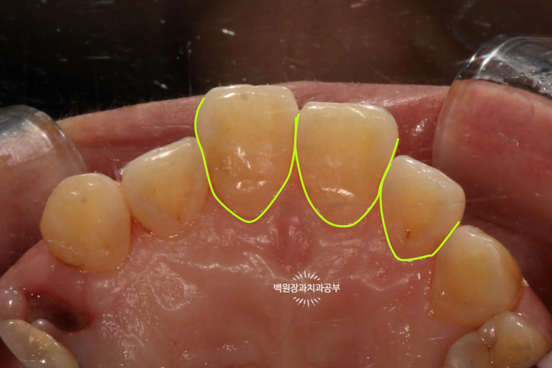 앞니레진치료 할 줄 모르는 치과의사는 없지만, 좋은 레진으로 치료하는 치과의사는 잘 없습니다. 관련 이미지 28