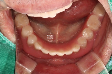 아래 어금니 임플란트 6개면 틀니를 안써도 됩니다.  치주염 전문 착한치과. 치료기간/임시치아과정/후기/비용. 관련 이미지 7