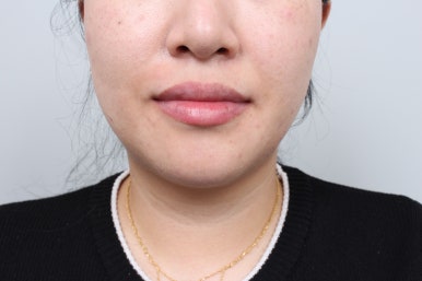 서울 신사역 [레브치과] 치아미백으로 해결 안되는 누렁니를, 하얗고 가지런한 앞니로 환한 미소를! 레브네이트 베이직 살펴보기. 관련 이미지 12