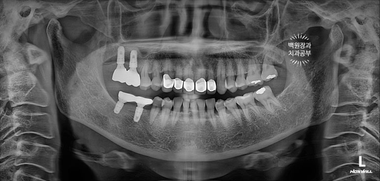 삐뚤빼뚤 앞니 세로 금  - 신경치료 없이 지르코니아 크라운으로. 상악동뼈이식술 임플란트. 관련 이미지 18