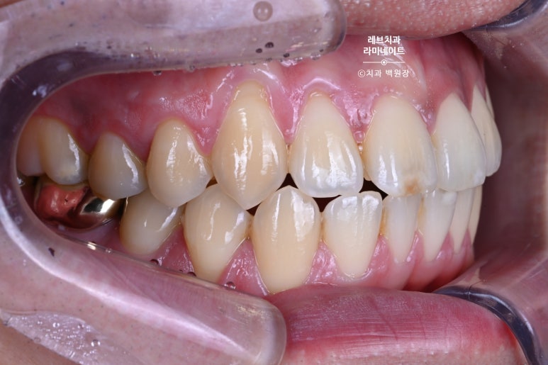 레브네이트 마스터 ; 예비신랑 앞니 무삭제라미네이트. 신사역 치과. 치료후기/비용/가격. 관련 이미지 6