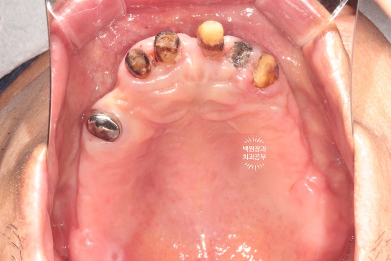 임플란트틀니 - 오버덴쳐. 오스템BA임플란트 이용한 최고의 가성비 치료. 치료과정/치료기간/비용/후기. 관련 이미지 5