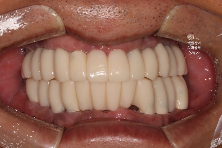 만성치주염으로 인해 아주 좁아진 잇몸뼈에 광범위한 뼈이식 + 전체임플란트. 신사 레브치과. 관련 이미지 50