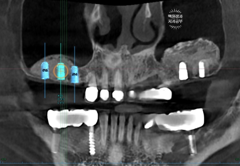부분틀니 대신 어금니 임플란트를 만들어드립니다. 40대 어금니 상악동 뼈이식 임플란트. 치료기간/비용/과정. 관련 이미지 17