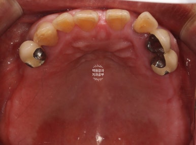 임플란트장인의 마음으로 8개월간 전체임플란트 완성. 치주과 전문의. 관련 이미지 6