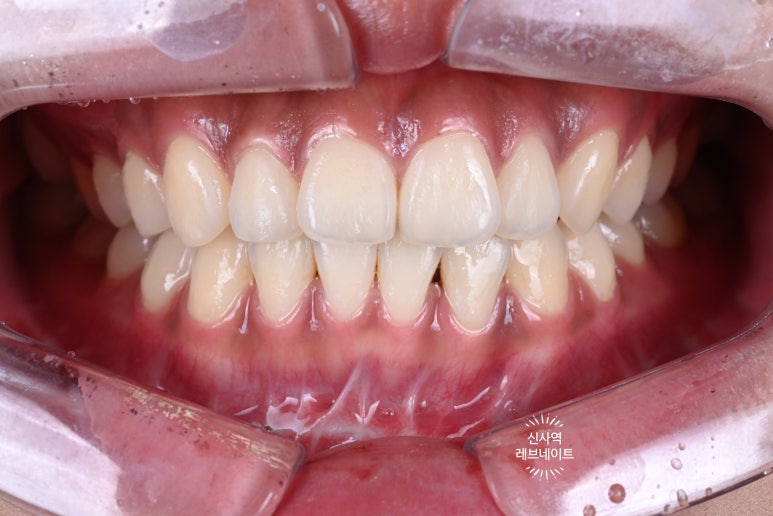 What About Laminates at Sinsa Station? Rev Dental Clinic’s Revnate. image 2