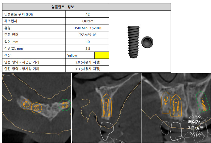 만성치주염으로 인해 아주 좁아진 잇몸뼈에 광범위한 뼈이식 + 전체임플란트. 신사 레브치과. 관련 이미지 13