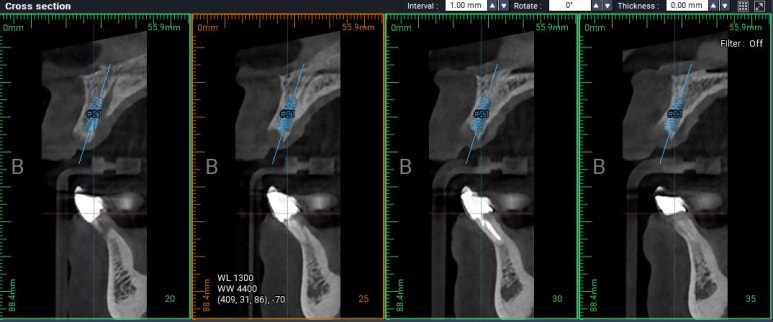 앞니가 풍치로 흔들거려요. 심한 치주염인데 임플란트 가능할까요? 치료과정/치료기간/비용/성공후기. 신금호역 치과 추천. 관련 이미지 14