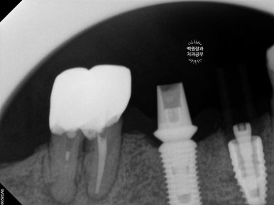 스트라우만 임플란트로 이뽑고 바로심는치과 - 믿고 사용하는 세계 1위 스위스 임플란트 회사. 관련 이미지 25