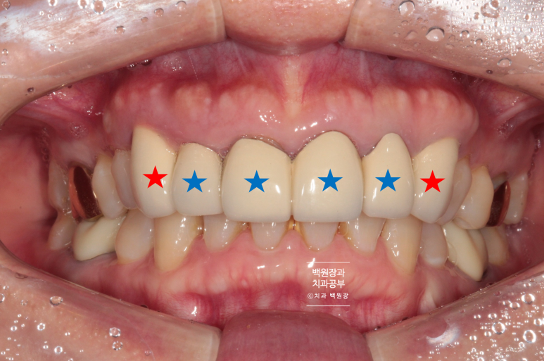크라운 앞니 충치로 냄새가 나요 - 최소한의 임플란트와 씌우는 치료. 치료과정/기간/비용. 관련 이미지 3