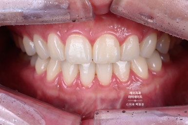 레브네이트 베이직. 치아미백과 치아교정을 한번에! 치아삭제 사진 있음. 신사역 치과 앞니라미네이트 모델/비용/후기. 관련 이미지 20