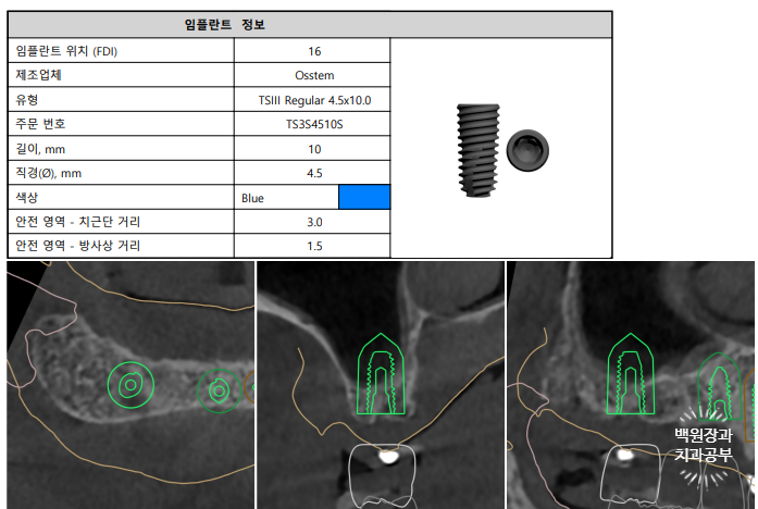 만성치주염으로 인해 아주 좁아진 잇몸뼈에 광범위한 뼈이식 + 전체임플란트. 신사 레브치과. 관련 이미지 15