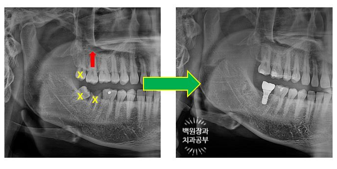아래 어금니가 없어 위 어금니가 내려왔어요. 부분 교정을 곁들인 스트라우만 임플란트 수술. 억울한 신경치료를 피해보자. 치료과정/치료기간/비용/후기. 관련 이미지 17