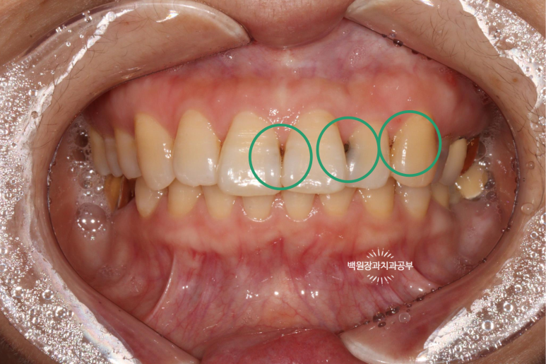 앞니레진치료 할 줄 모르는 치과의사는 없지만, 좋은 레진으로 치료하는 치과의사는 잘 없습니다. 관련 이미지 12