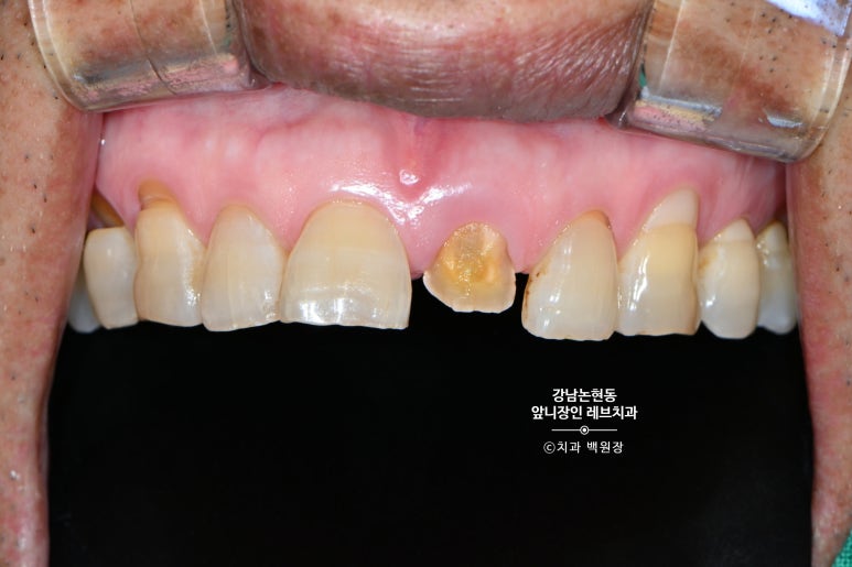 강남논현동치과 60대 치아부러짐 - 신경치료하고 기둥심고 앞니 크라운 잘하는곳! 가격/과정/후기/부작용. 관련 이미지 7