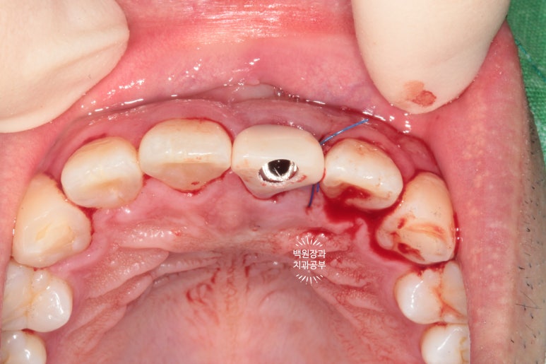 앞니 머리가 기둥째 부러졌어요. 발치 동시 뼈이식 오스템 BA 임플란트. 치료과정/치료기간/비용/후기. 압구정 치과. 관련 이미지 15