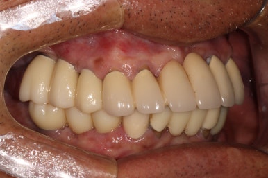 잇몸 염증 고름이 심했던 부위 - 만성치주염 진단하고 임플란트로 깔끔하게 치료! 신사역 치과 관련 이미지 29