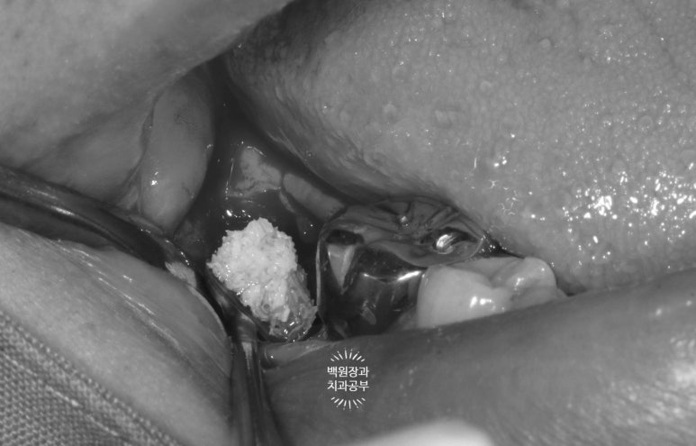 신경치료한 치아 부러짐! 뼈이식 하면서 임플란트 수술하는 과정/기간/비용. 관련 이미지 7