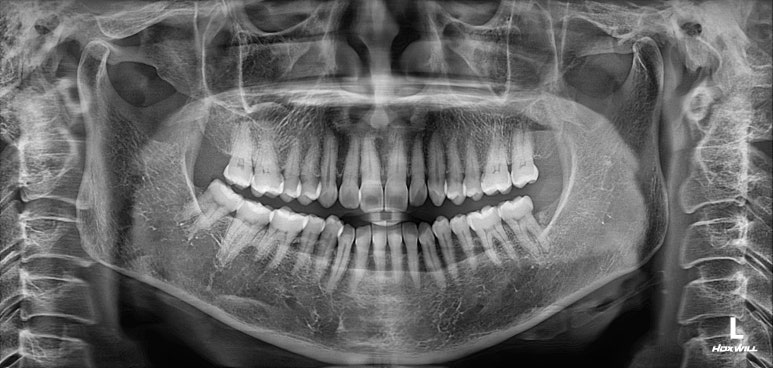 치아크랙 (금간 치아)의 찌릿한 통증 - 발치하지 않고 살려보기. 원인/진단/치료과정/비용/기간. 보존과전문의 치과. 관련 이미지 2