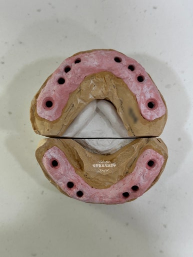 오스템임플란트 네비게이션 전체 임플란트 치료일기. 치료과정/치료기간/비용/솔직후기. 관련 이미지 28