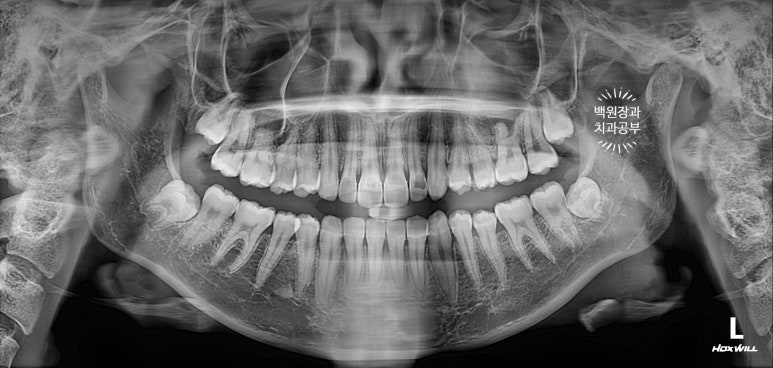 잇몸치료와 앞니 레진치료. 3년이 지난 모습 궁금하지 않으신가요? 3M 레진쓰는 치과. 후기/시간/과정/비용. 관련 이미지 3