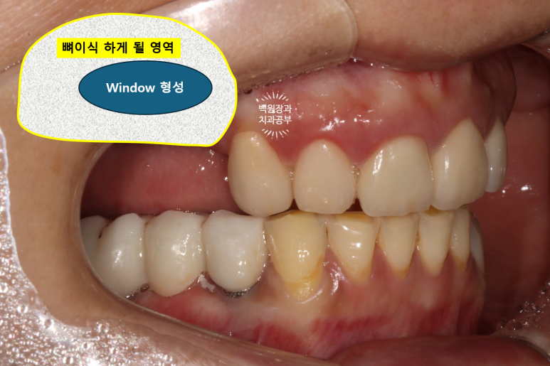 부분틀니 대신 어금니 임플란트를 만들어드립니다. 40대 어금니 상악동 뼈이식 임플란트. 치료기간/비용/과정. 관련 이미지 7