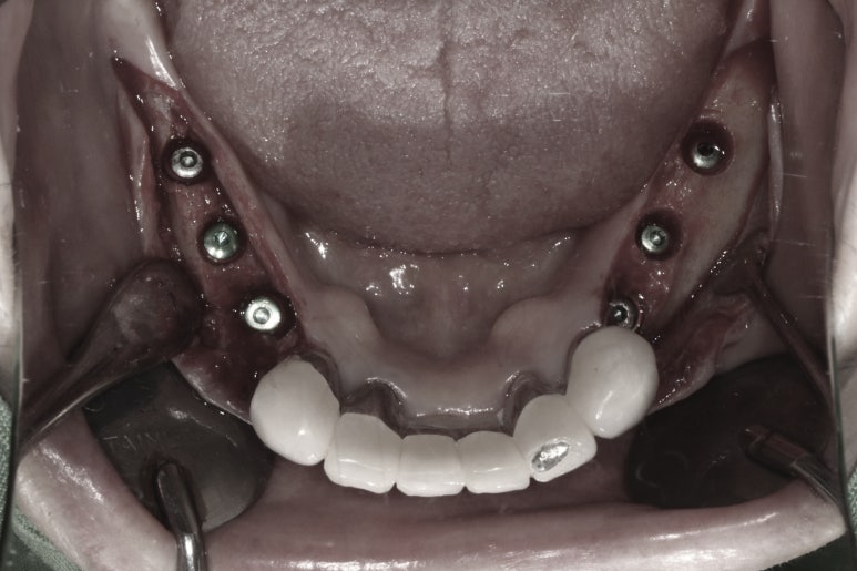 부분틀니를 오래써서 어금니가 아플 때, 아래턱 양쪽 어금니 임플란트 잘하는 강남임플란트치과 관련 이미지 10