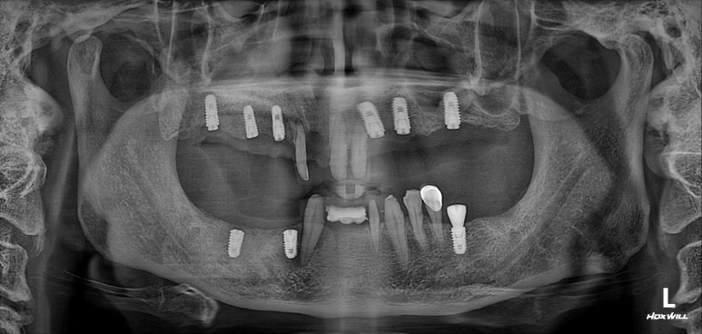 큰 어금니를 잃을 정도의 풍치를 앓으셨다면, 조속한 어금니 임플란트는 필수입니다. 관련 이미지 11