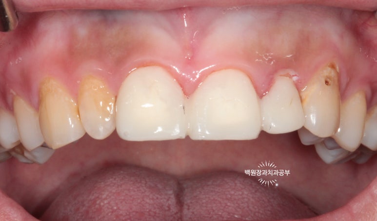 앞니에 잇몸염증과 충치가 심해요. 앞니 지르코니아 크라운 성공 후기. 치료과정/치료기간/비용/전후비교. 관련 이미지 11