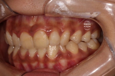 잇몸치료와 앞니 레진치료. 3년이 지난 모습 궁금하지 않으신가요? 3M 레진쓰는 치과. 후기/시간/과정/비용. 관련 이미지 11
