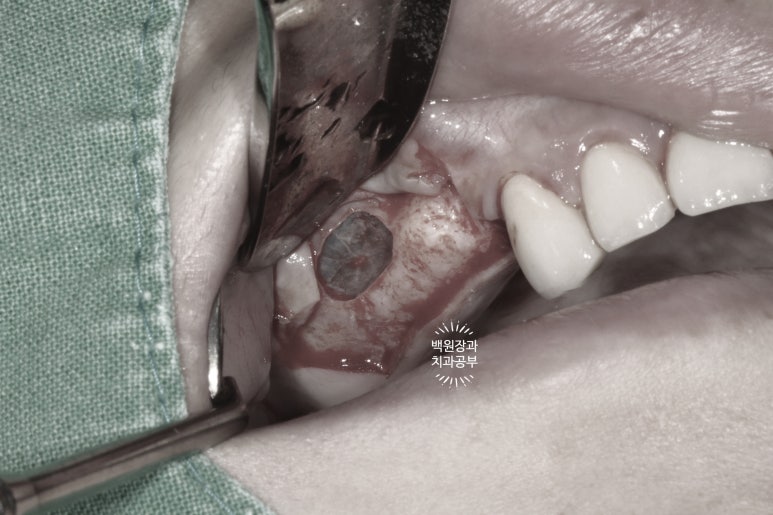 부분틀니 대신 어금니 임플란트를 만들어드립니다. 40대 어금니 상악동 뼈이식 임플란트. 치료기간/비용/과정. 관련 이미지 8