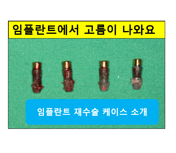 임플란트에서 고름이 나와요. 임플란트 주위염 그리고 재수술을 위한 준비. 치료과정/치료기간/비용/후기. 관련 이미지 1