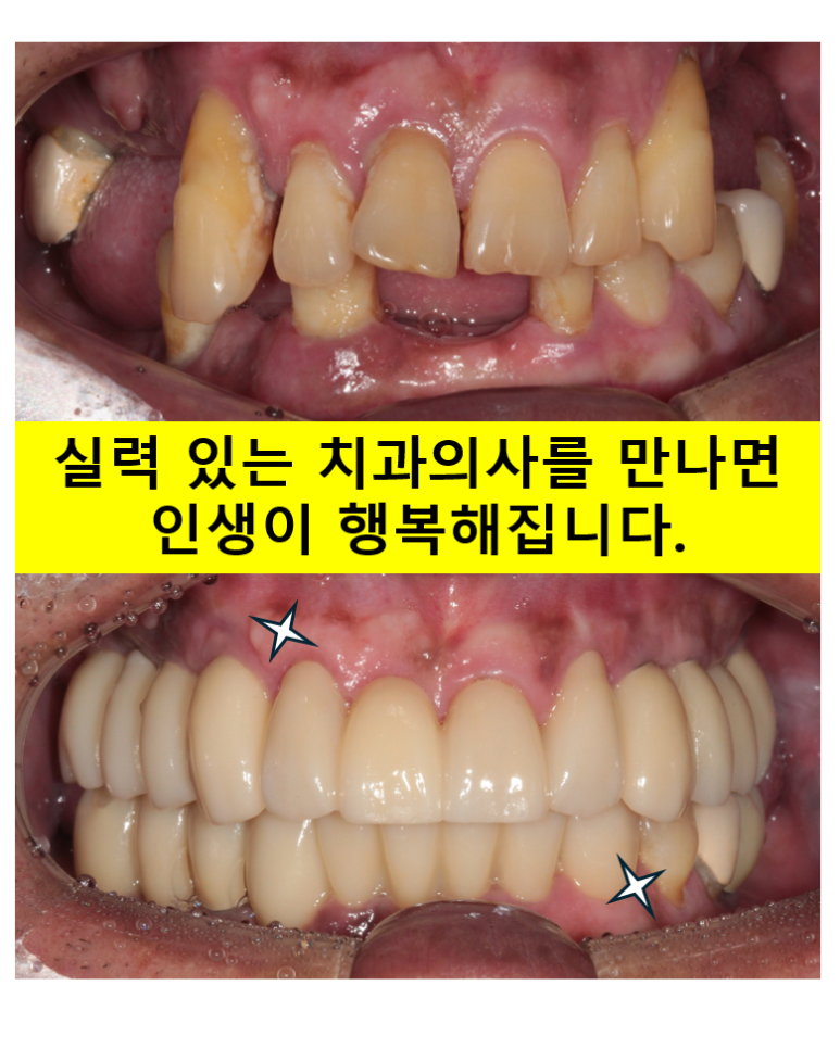 큰 어금니를 잃을 정도의 풍치를 앓으셨다면, 조속한 어금니 임플란트는 필수입니다. 관련 이미지 1