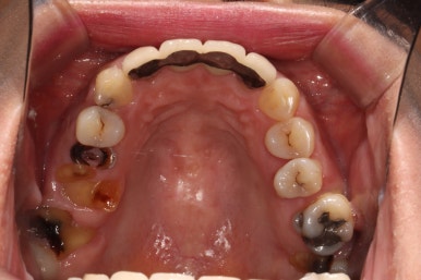 전세계 1위 스트라우만 임플란트를 사용한 어금니 기능회복과 앞니 지르코니아 크라운 증례. 관련 이미지 6