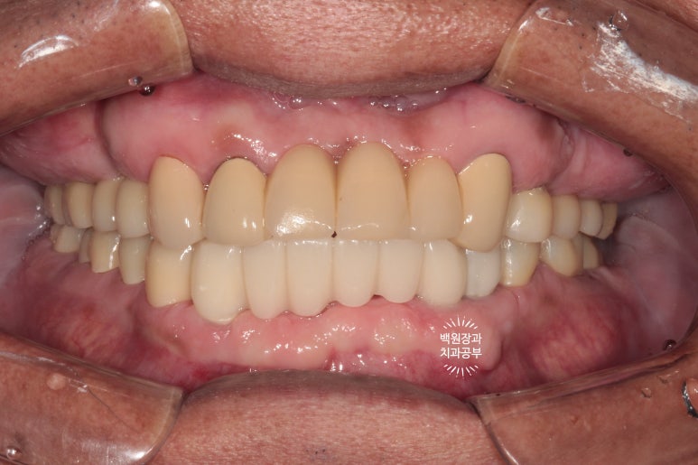 뿌리만 남은 앞니, 어금니가 없어 교합이 무너진 증례. 흡연자의 전체 오스템BA임플란트 재건증례. 치료과정/치료기간/비용/후기. 관련 이미지 20