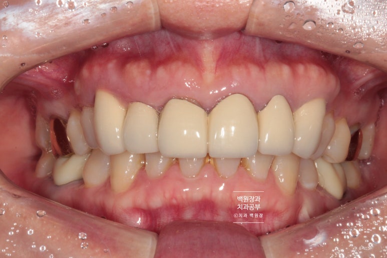 크라운 앞니 충치로 냄새가 나요 - 최소한의 임플란트와 씌우는 치료. 치료과정/기간/비용. 관련 이미지 2