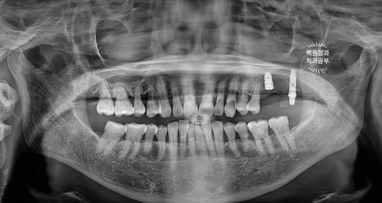 치아와 임플란트를 연결하면 치아가 망가집니다. 발치 동시 치조골 이식 후 임플란트. 치료과정/치료기간/비용/후기. 관련 이미지 14