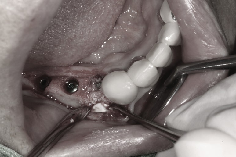 부분틀니를 오래써서 어금니가 아플 때, 아래턱 양쪽 어금니 임플란트 잘하는 강남임플란트치과 관련 이미지 11